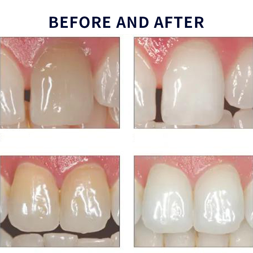 Opalescentie Whitening 20% Pf  - Teeth Whitening Flash recensie en prijs