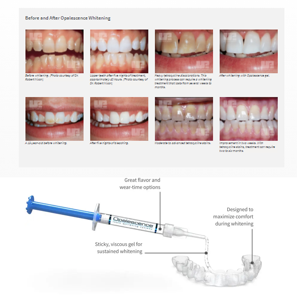 Opalescentie Whitening 20% Pf  - Teeth Whitening Flash recensie en prijs
