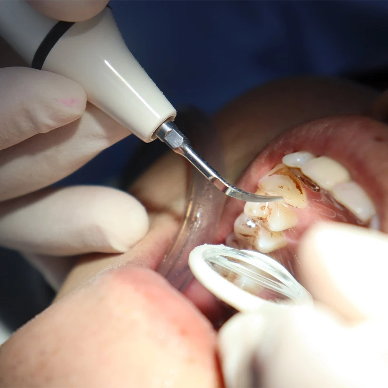 Scaler Handstuk Buis Kabel voo - Teeth Whitening Youtube recensie en prijs
