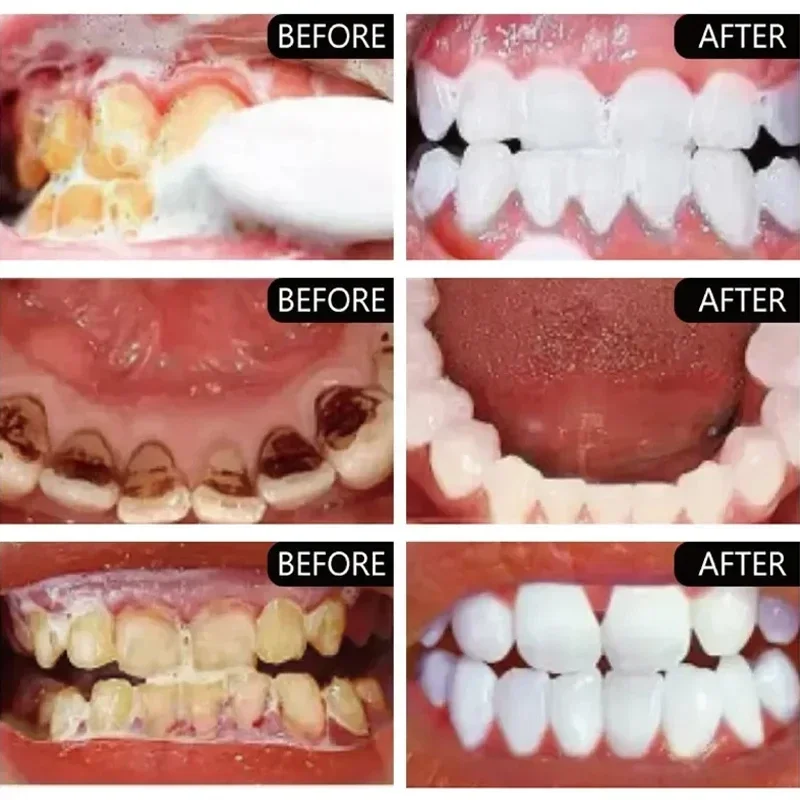 Snel Verwijderen Rookvlekken T - Teeth Whitening Fast recensie en prijs