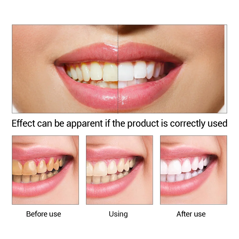 Fteenply Tanden Whitening Esse - Teeth Whitening Quotes recensie en prijs