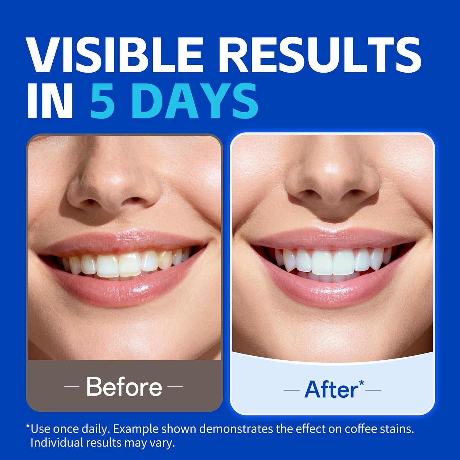 1/7 paar tandenbleekstrips voo - Teeth Whitening Retainer recensie en prijs